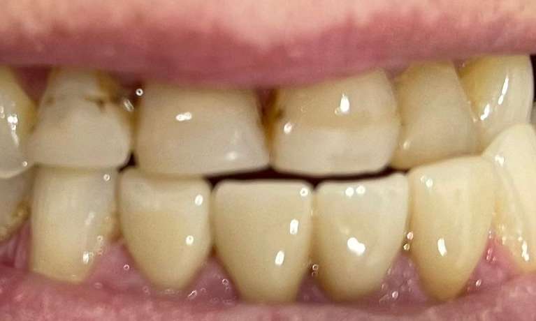 Dental-Crowns-On-Lower-Front-Teeth-After-Image