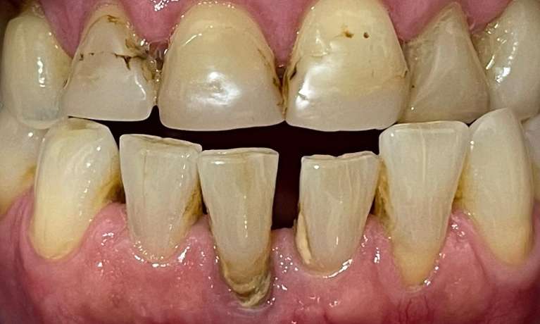 Dental-Crowns-On-Lower-Front-Teeth-Before-Image