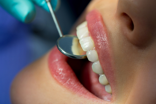 Close-up,Medical,Dentist,Procedure,Of,Teeth,Cleaning.,Beautiful,Young,Woman