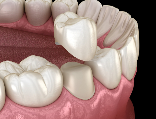 Dental,Crown,Premolar,Tooth,Assembly,Process.,Medically,Accurate,3d,Illustration